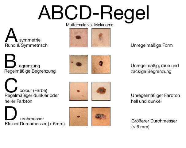 Muttermale kontrollieren - bösartiges Muttermal - normales Muttermal